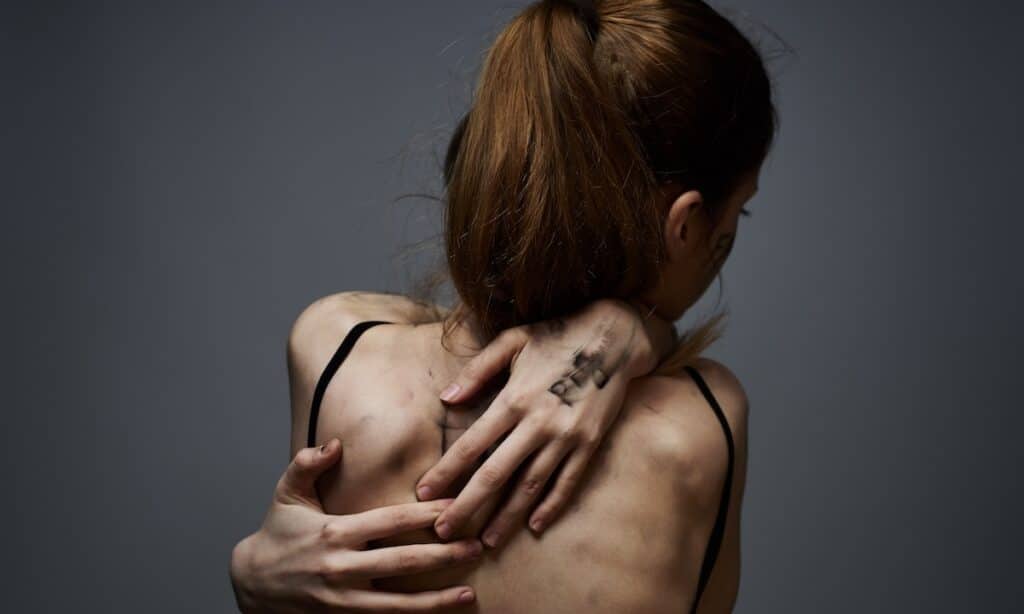 Back view of a thin woman hugging herself, illustrating the physical impact of anorexia.